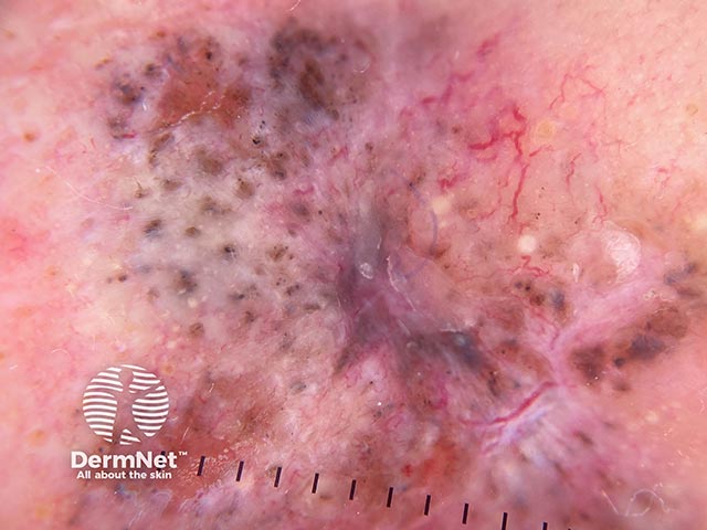 A pigmented basal cell carcinoma on dermoscopy - note the broken telangiectasia and pigment flecks