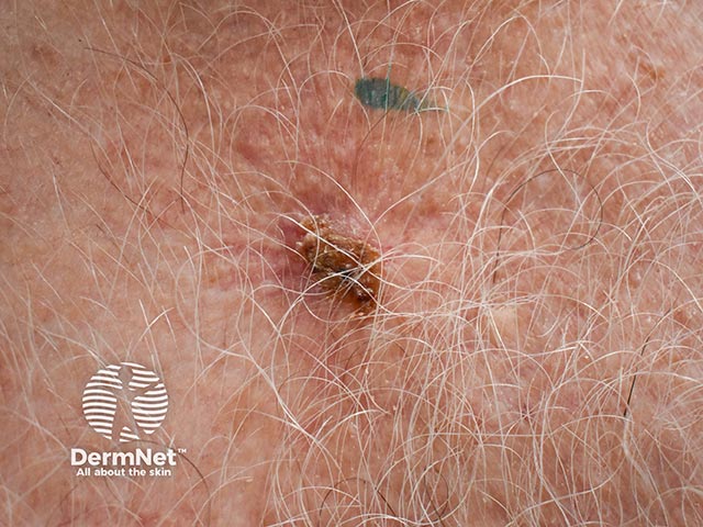 Close-up of a basal cell carcinoma - crust is obliterating some of the diagnostic features