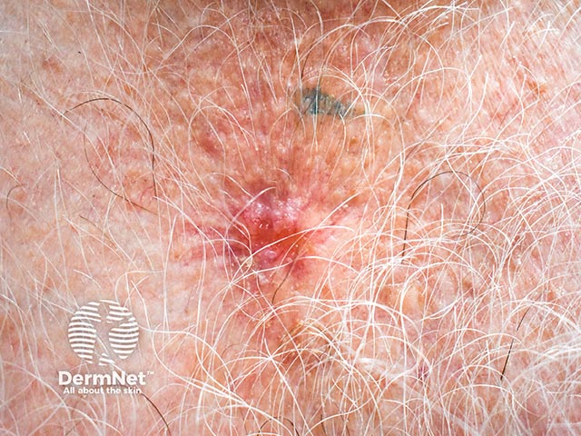 The glassy periphery and central ulceration revealed after removing the crust