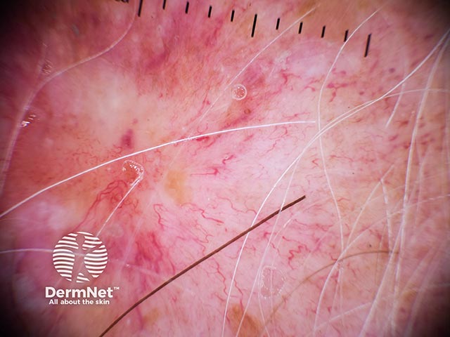 Dermoscopy shows the broken arborising telangiectasia and central featureless sclerosis