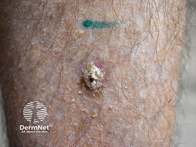 Basal cell carcinoma close-up with scale and crust obliterating the diagnostic features