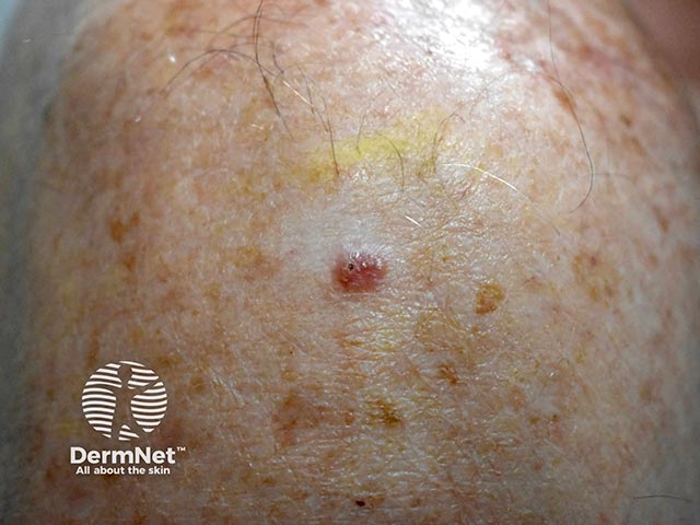 A basal cell carcinoma on the shoulder
