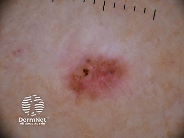 Dermoscopy shows telangiectasia and large pigment clods
