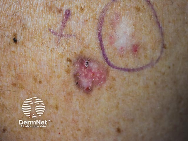 A basal cell carcinoma showing central atrophy and a pigmented periphery
