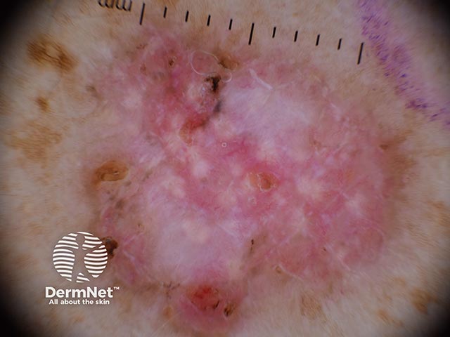 Dermoscopy of a basal cell carcinoma - pigmented clods, fine telangiectatic vessels, and central white-cream atrophy