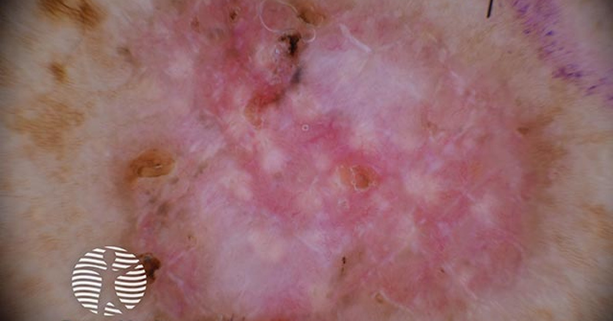 Basal cell carcinoma image