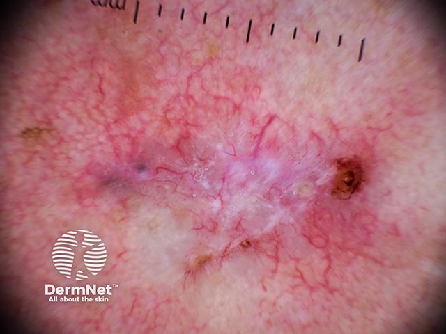 Dermoscopic image of a basal cell carcinoma on the lower leg