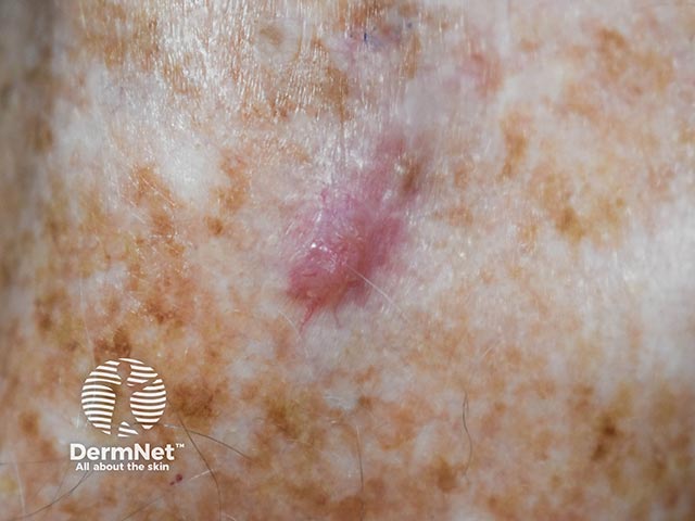 A small basal cell carcinoma on sun-damaged skin