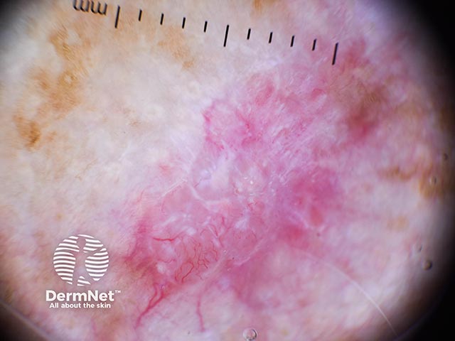 Dermoscopy shows white-pink areas and telangiectatic vessels