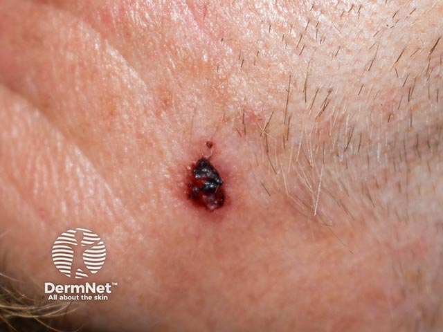 An ulcerated basal cell carcinoma on the temple