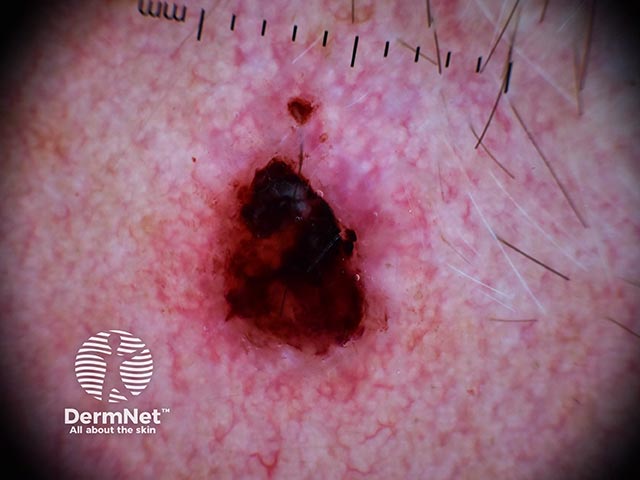 Dried blood obscures many diagnostic dermatoscopic features