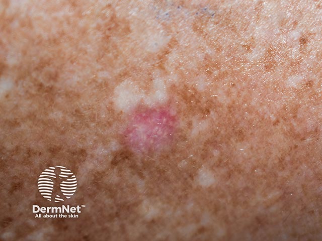 A basal cell carcinoma on sun-damaged skin