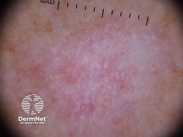 Dermoscopy shows white structureless areas and fine linear vessels