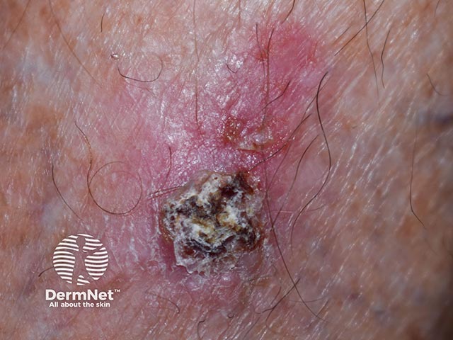 A crusted basal cell carcinoma on the lower leg
