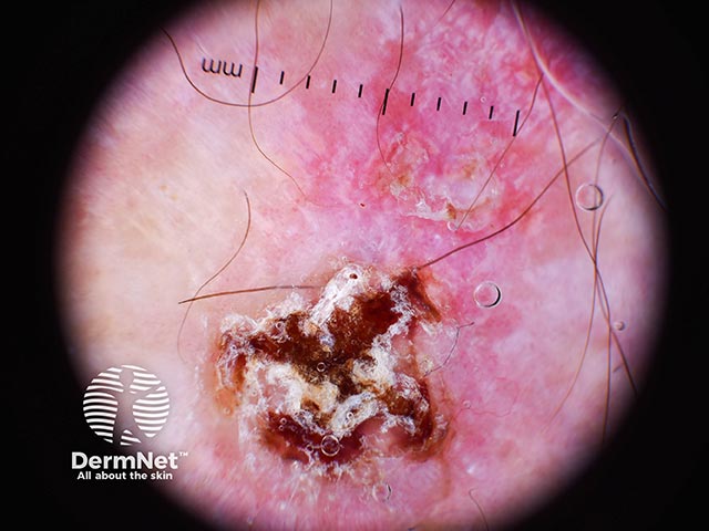 Dermoscopy showing crust and scale with pink-white area above