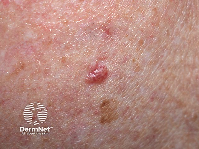 A small nodular basal cell carcinoma