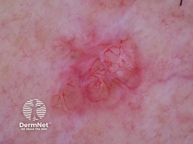 Dermoscopy shows white-grey areas and linear and branched telangiectasia