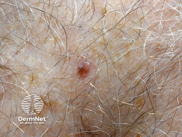 A small nodular basal cell carcinoma on the body