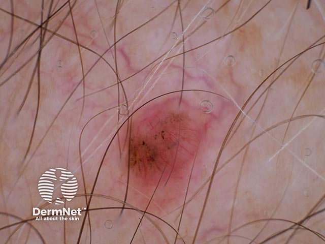 Dermoscopy showing clods of pigment and linear radial vessels