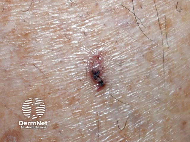 A basal cell carcinoma on the leg