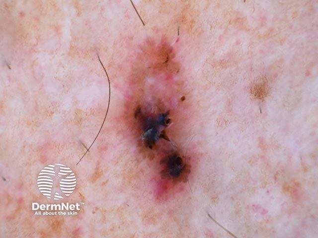 Dermoscopy of a basal cell carcinoma on the leg - note pigmentation and pink areas
