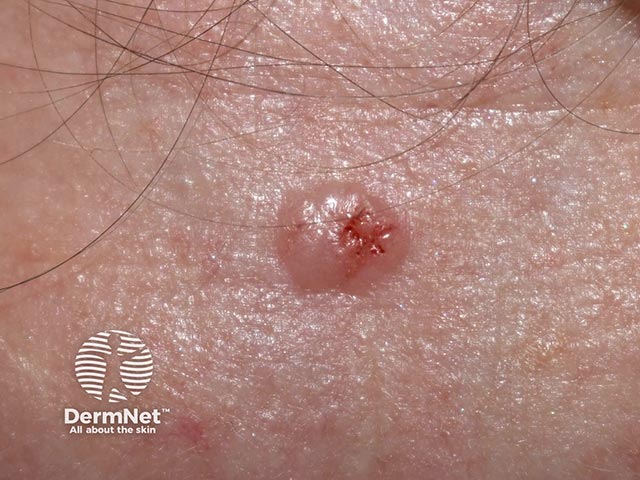 A nodular basal cell carcinoma on the forehead