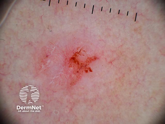 Dermoscopy of a nodular basal cell carcinoma
