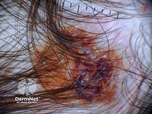 A crusted basal cell carcinoma on the scalp