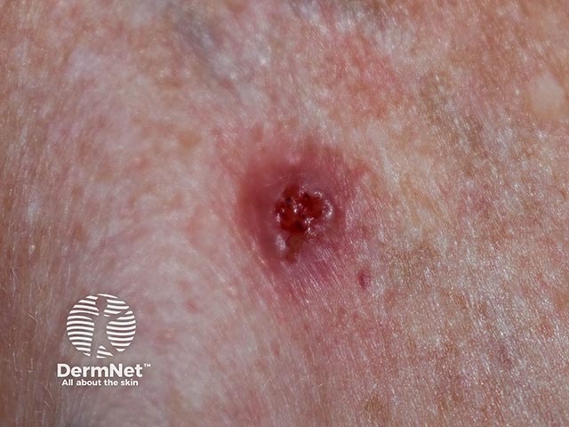 An ulcerated basal cell carcinoma - note the pearly raised edge