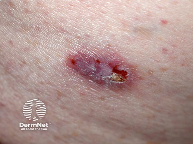 An ulcerated basal cell carcinoma on the leg