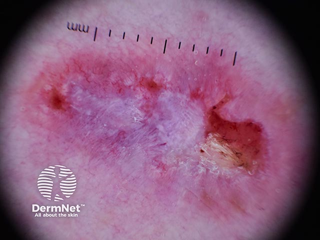 Dermoscopy of a basal cell carcinoma on the leg - note ulceration and peripheral telangiectasia and grey-white central islands