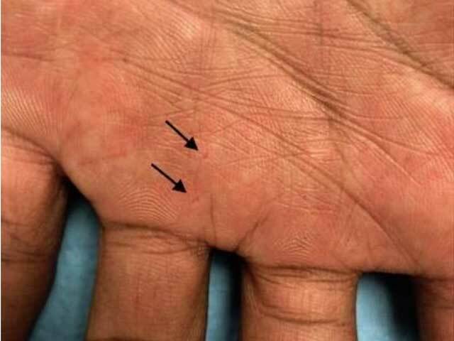 Basal cell naevus syndrome: palmar pits