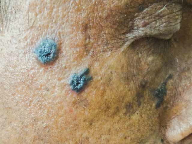 Bazex‑Dupré‑Christol syndrome: pigmented basal cell carcinomas