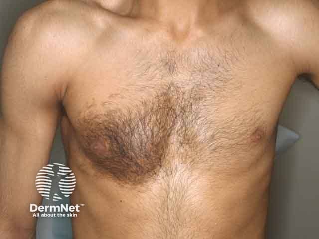 Hyperpigmentation and hypertrichosis over the chest in Becker naevus