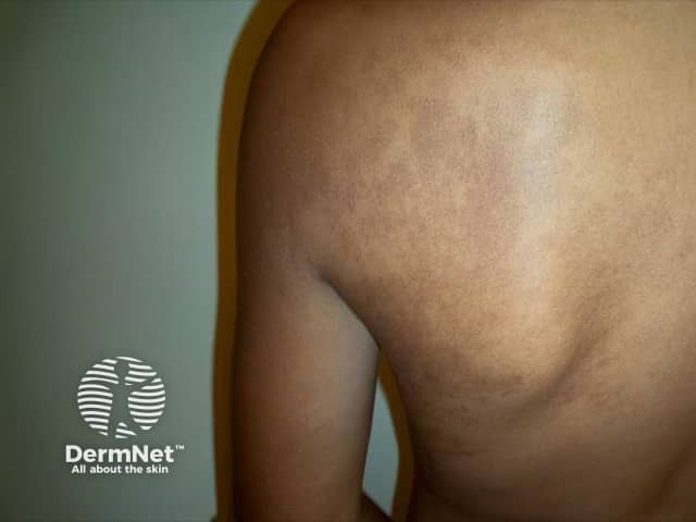 Pigmentation due to Becker melanosis - hypertrichosis developed later 