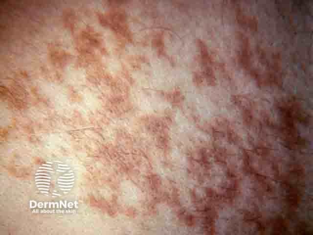 Close up of Becker melanosis