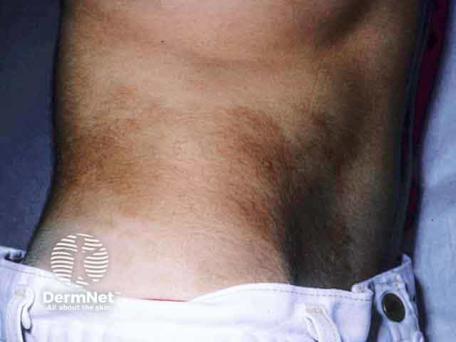 Pigmentation and hypertrichosis over the abdomen in Becker naevus