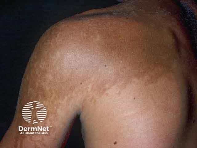 Pigmentation and hypertrichosis over the shoulder in Becker naevus