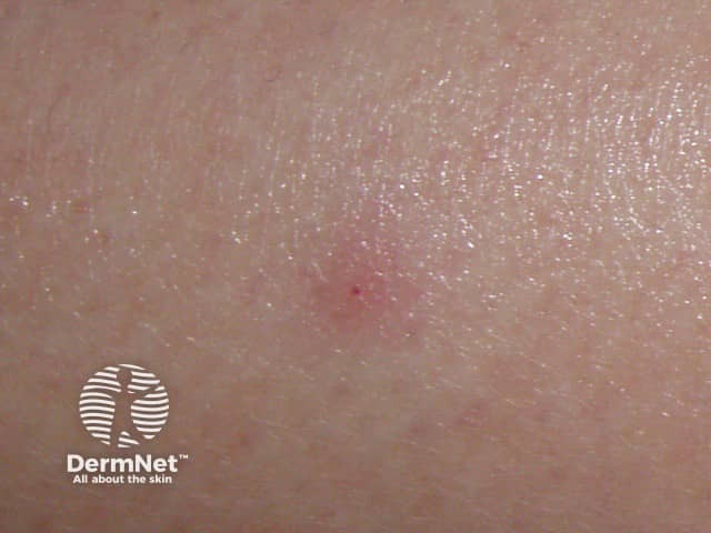 Bed bug bite on the calf - note the central punctum