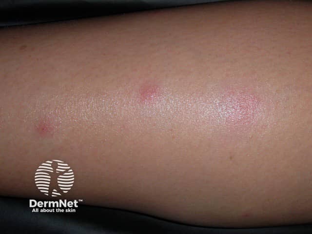 Bed bug bites on the calf
