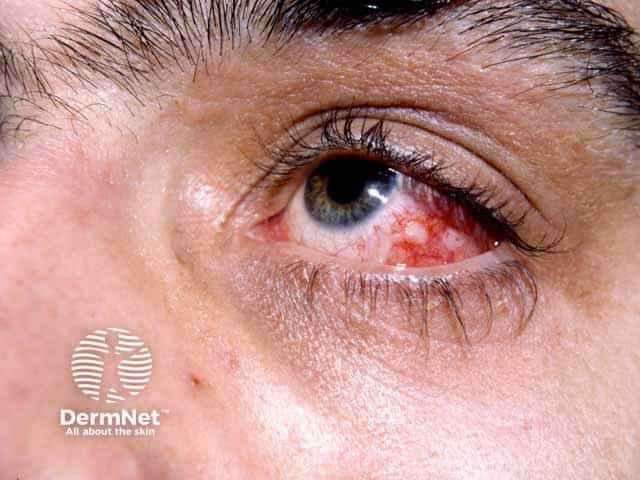 Behçet disease - eye
