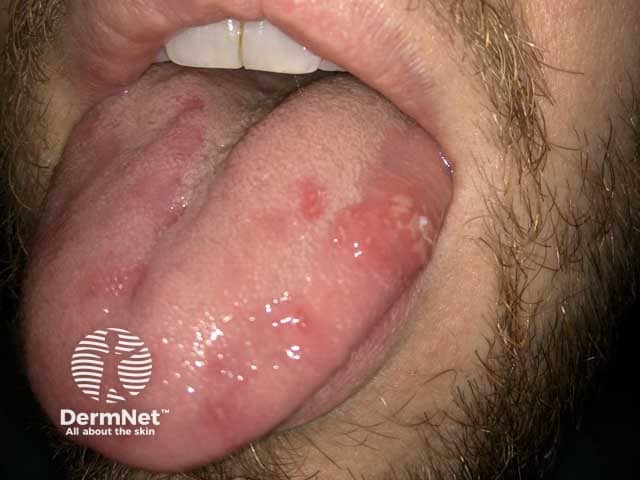 Behçet disease - tongue