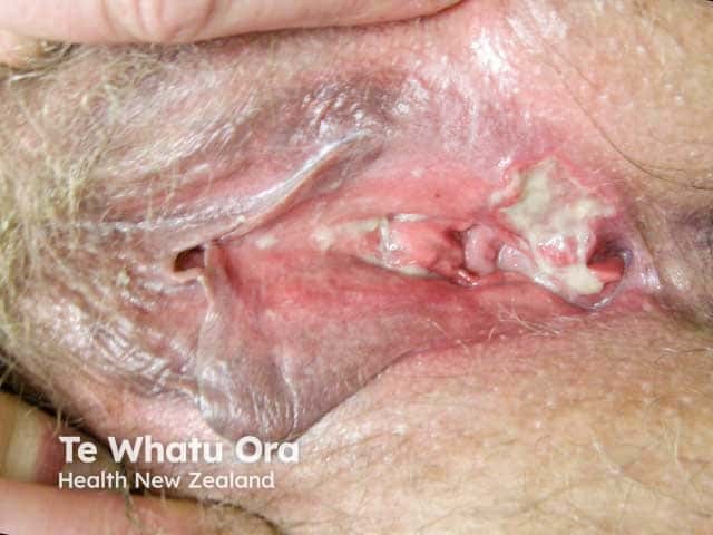 Ulcers in vulval Behcet disease