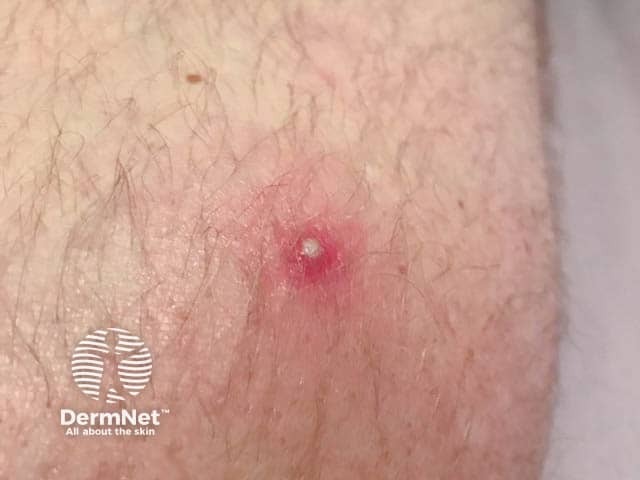 Behçet disease - pustular lesion on arm
