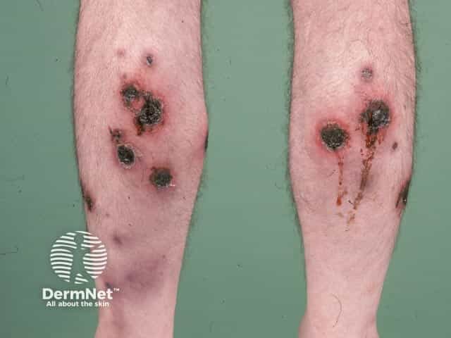 Pyoderma like lesions in Behcet disease