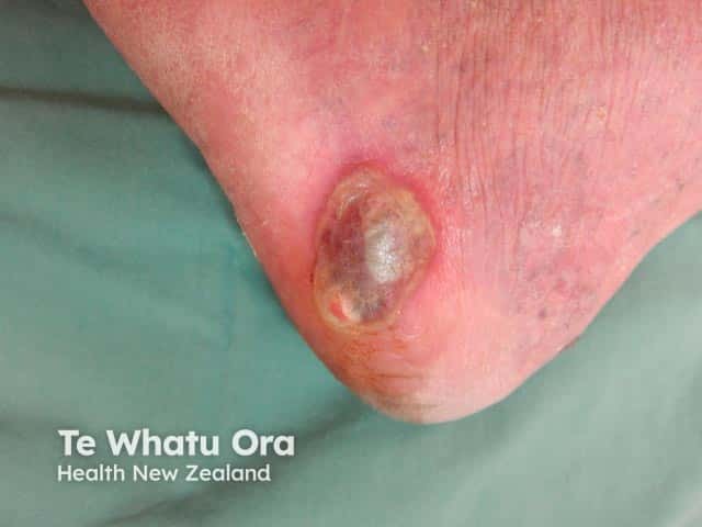 Ankle ulcer in Behcet disease