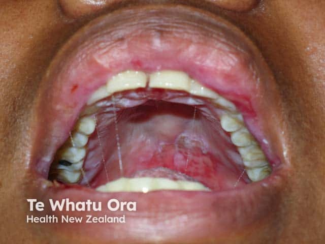 Oral elsions in Behcet disease