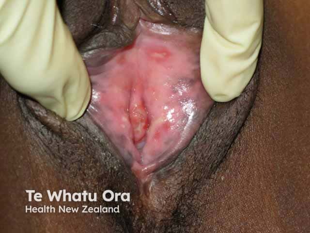 Vulval aphthae in Behcet disease