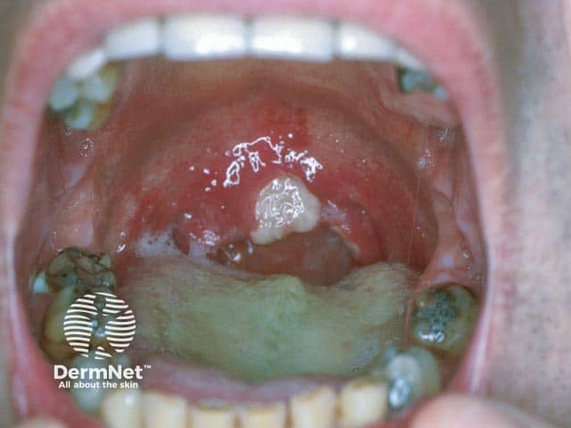 Large ulcer in Behcet disease causing uvular necrosis