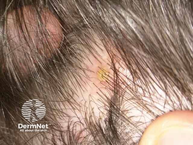 Scalp pustule in Behcet disease